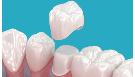 被せ物(クラウン)