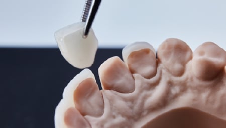 ラミネートベニア