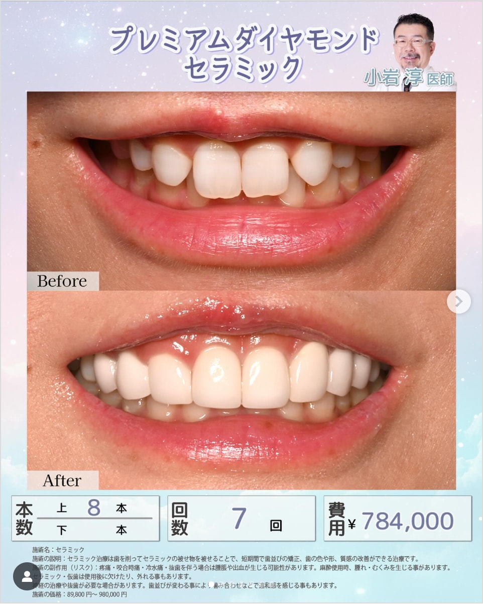 セラミック矯正(クラウン)