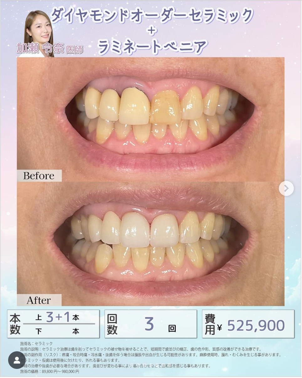 ラミネートべニア<br />