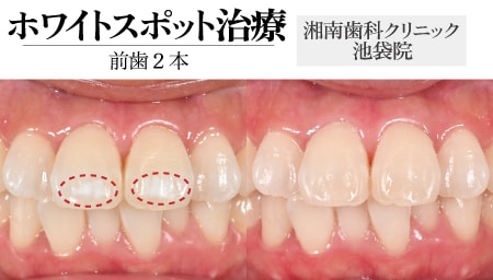 ホワイトスポット治療（iCON）