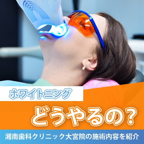 大宮駅周辺でホワイトニングするなら!湘南美容歯科大宮院【ホワイトニングってどうやるの?】