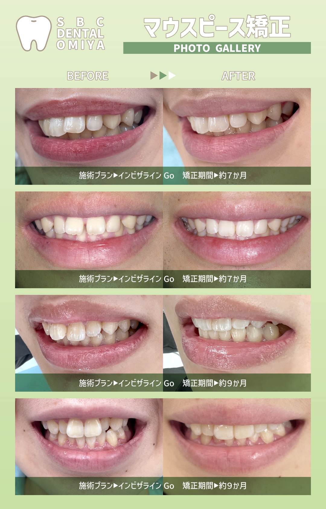 マウス ピース 矯正 期間