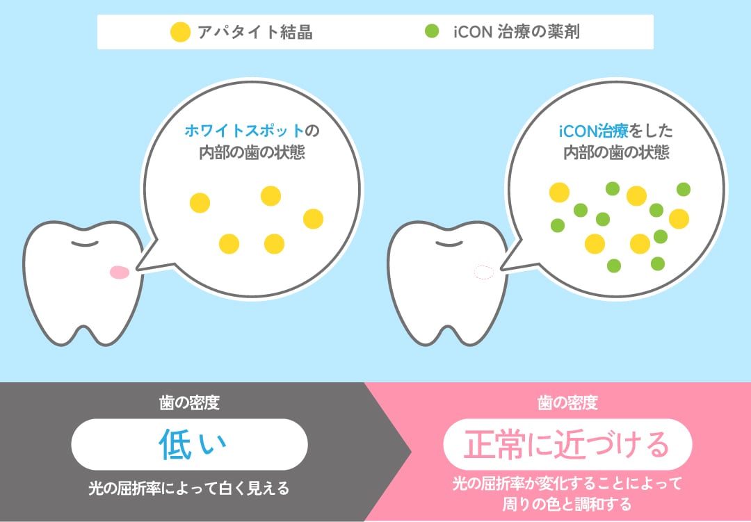 特殊な樹脂を歯の表面に浸透させて、歯の白濁を目立ちにくくする治療