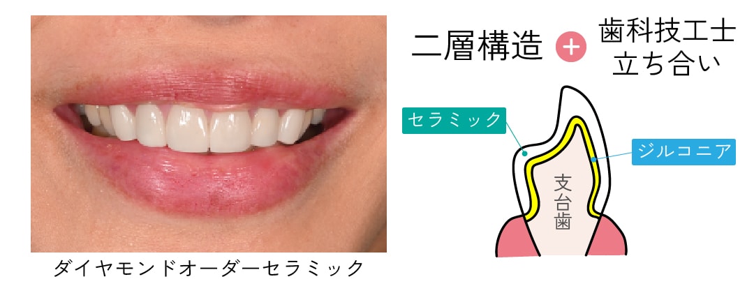 究極のオーダーメイドで理想の歯を再現したい方に