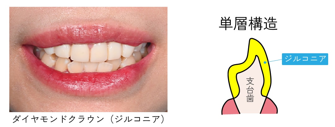コストを抑えて歯並びを改善したい方に