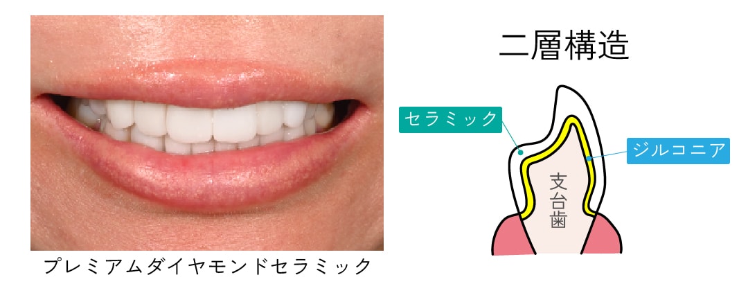 天然歯のような自然な美しさを求める方に