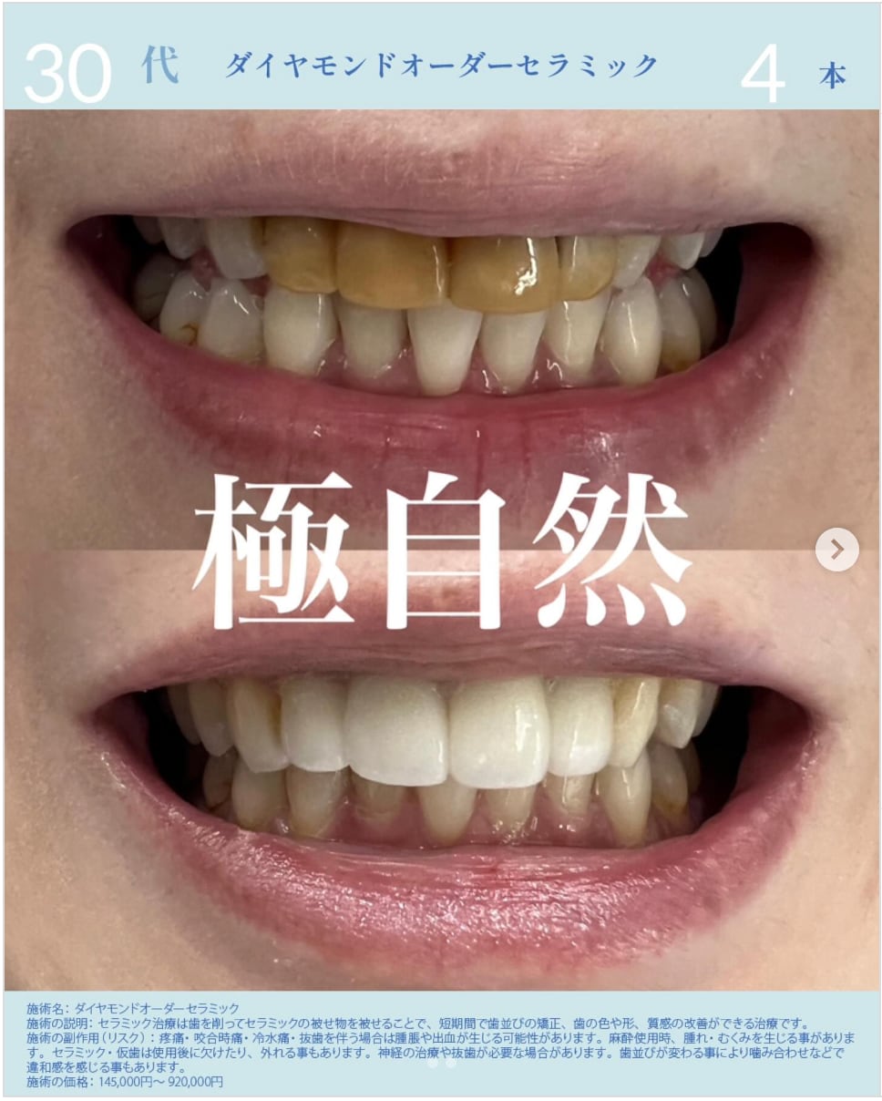 セラミック矯正（クラウン）