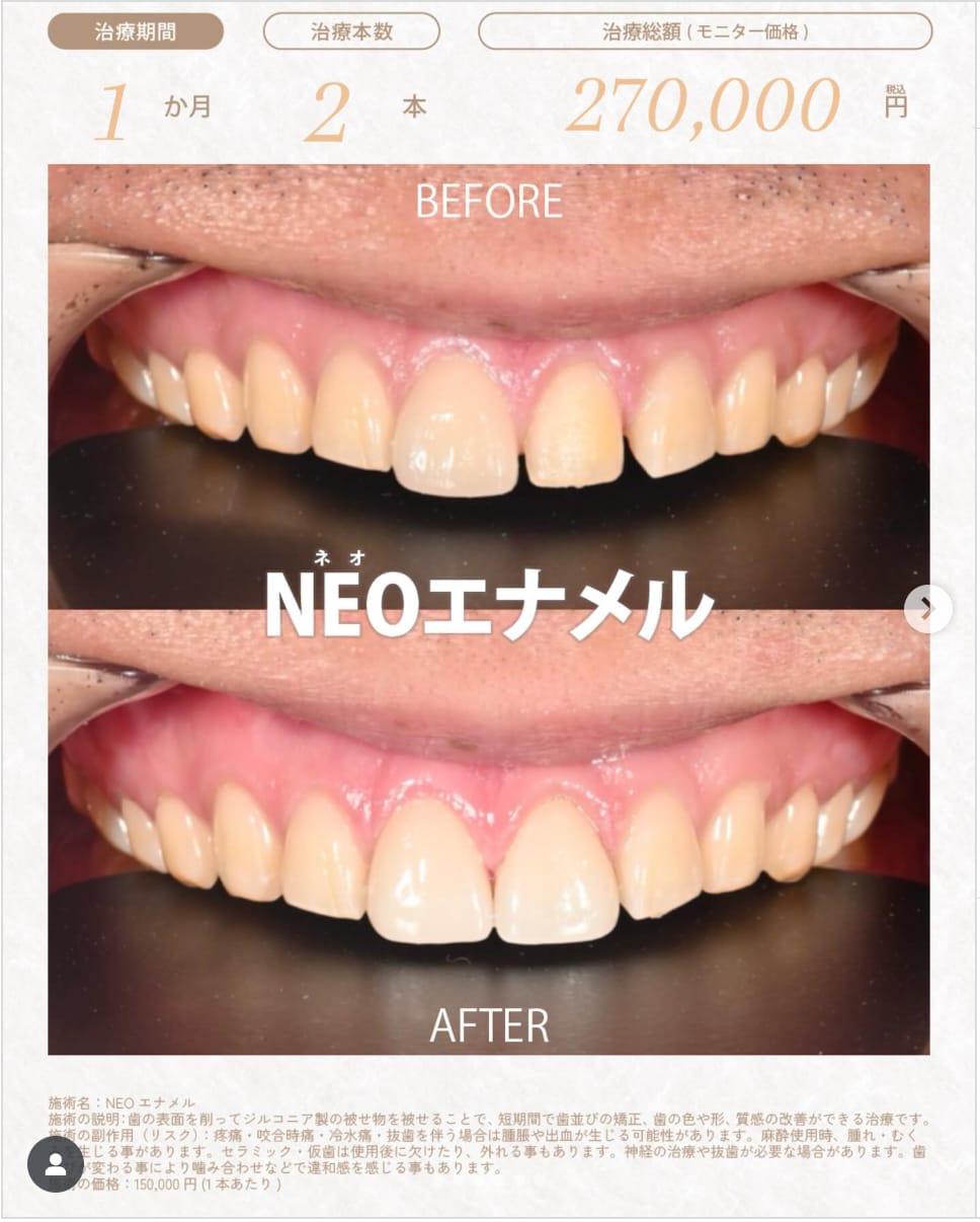 ラミネートべニア<br />
