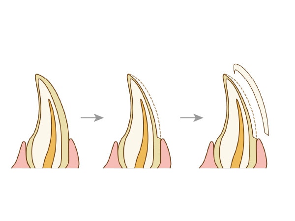 ラミネートベニア