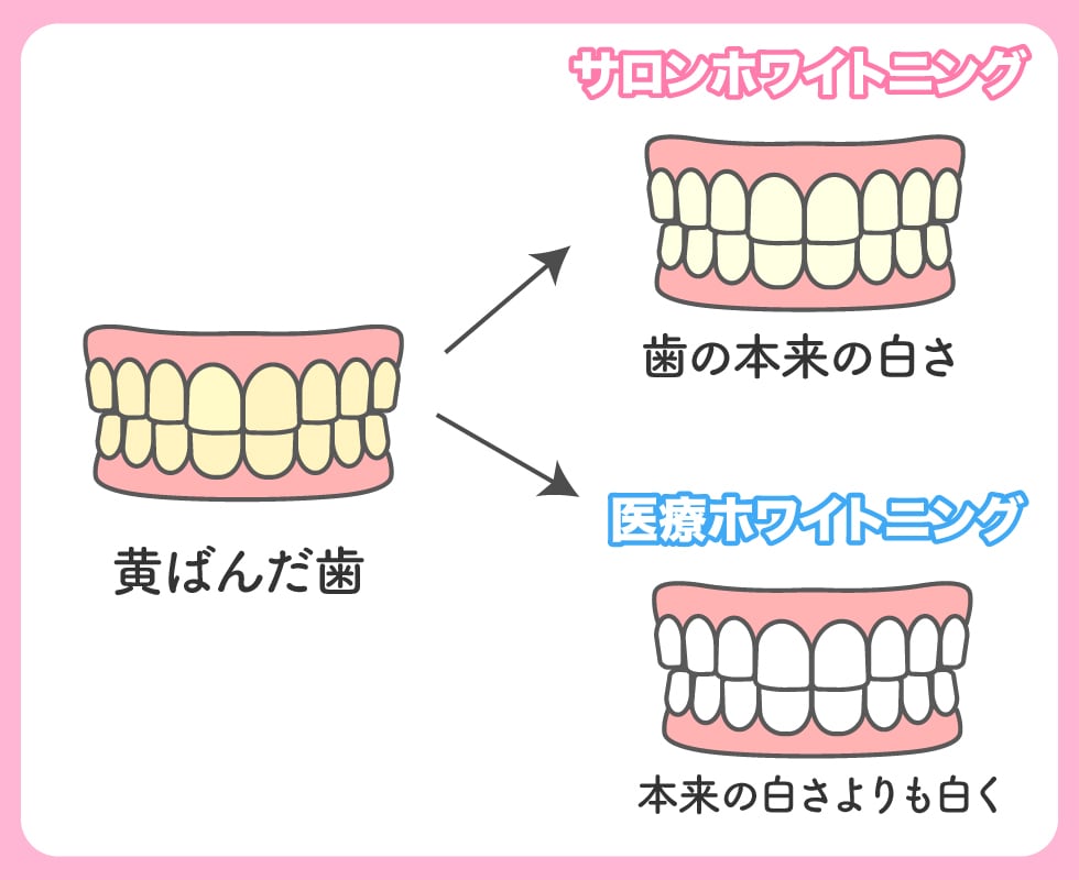医療ホワイトニングとサロンホワイトニングの違い