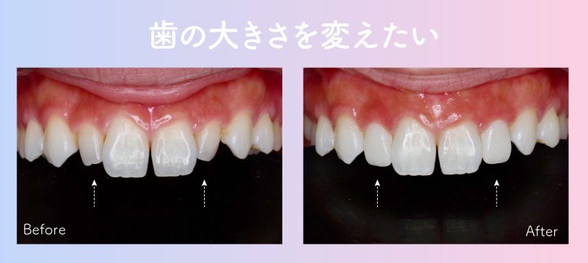 歯の大きさが気になる方