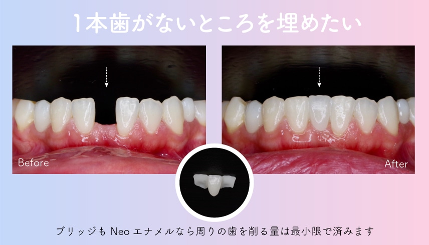 歯を削るのに抵抗がある・セラミックは抵抗がある方