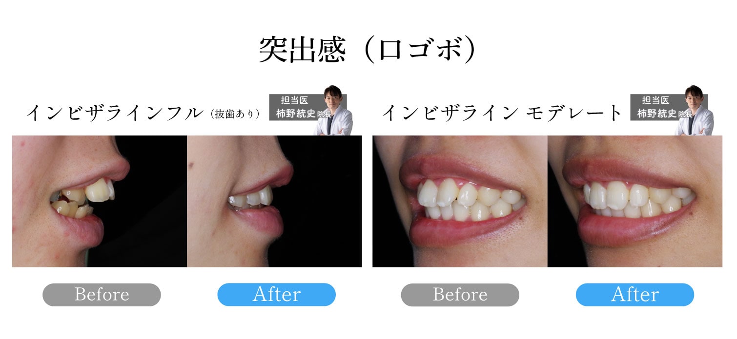 y*n様 マウスピース矯正における定番50の症例集「インビザライン症例 