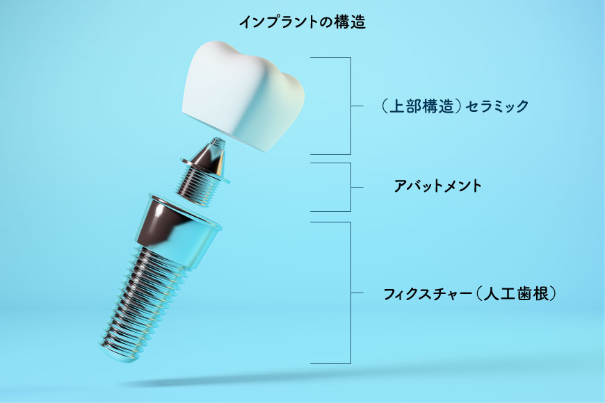 歯を失った際、これまではブリッジや入れ歯が一般的でしたが、「インプラント」が選ばれる方が増えています