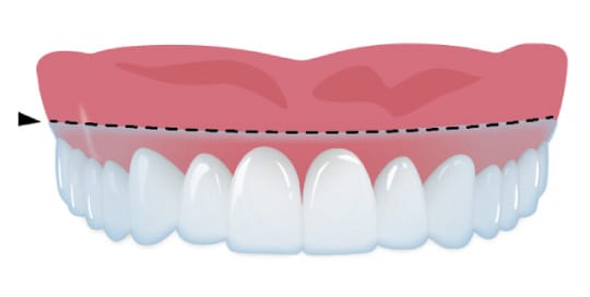 高い保持力を持つアライナー
