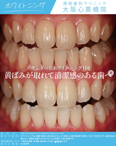 投稿①【スタンダードホワイトニング】