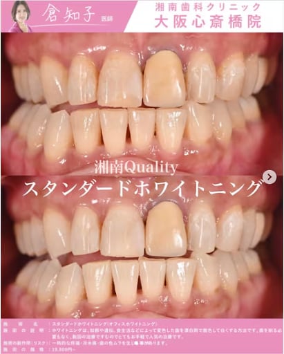投稿②【スタンダードホワイトニング】