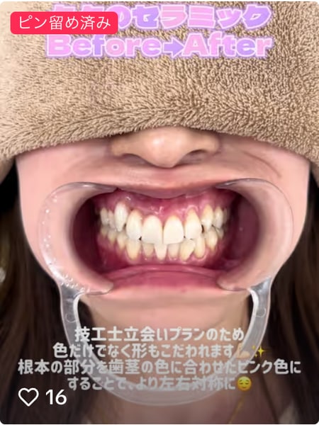 投稿①【セラミック治療】
