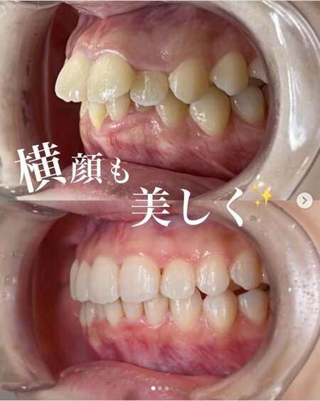 投稿③【マウスピース矯正】