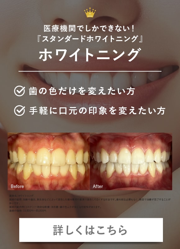【医療機関でしかできない】ホワイトニング