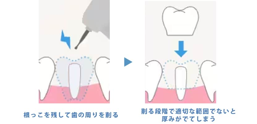 セラミック矯正へのこだわり