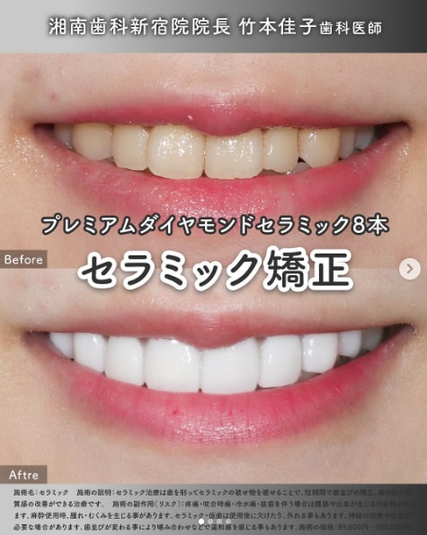 セラミック矯正（クラウン）