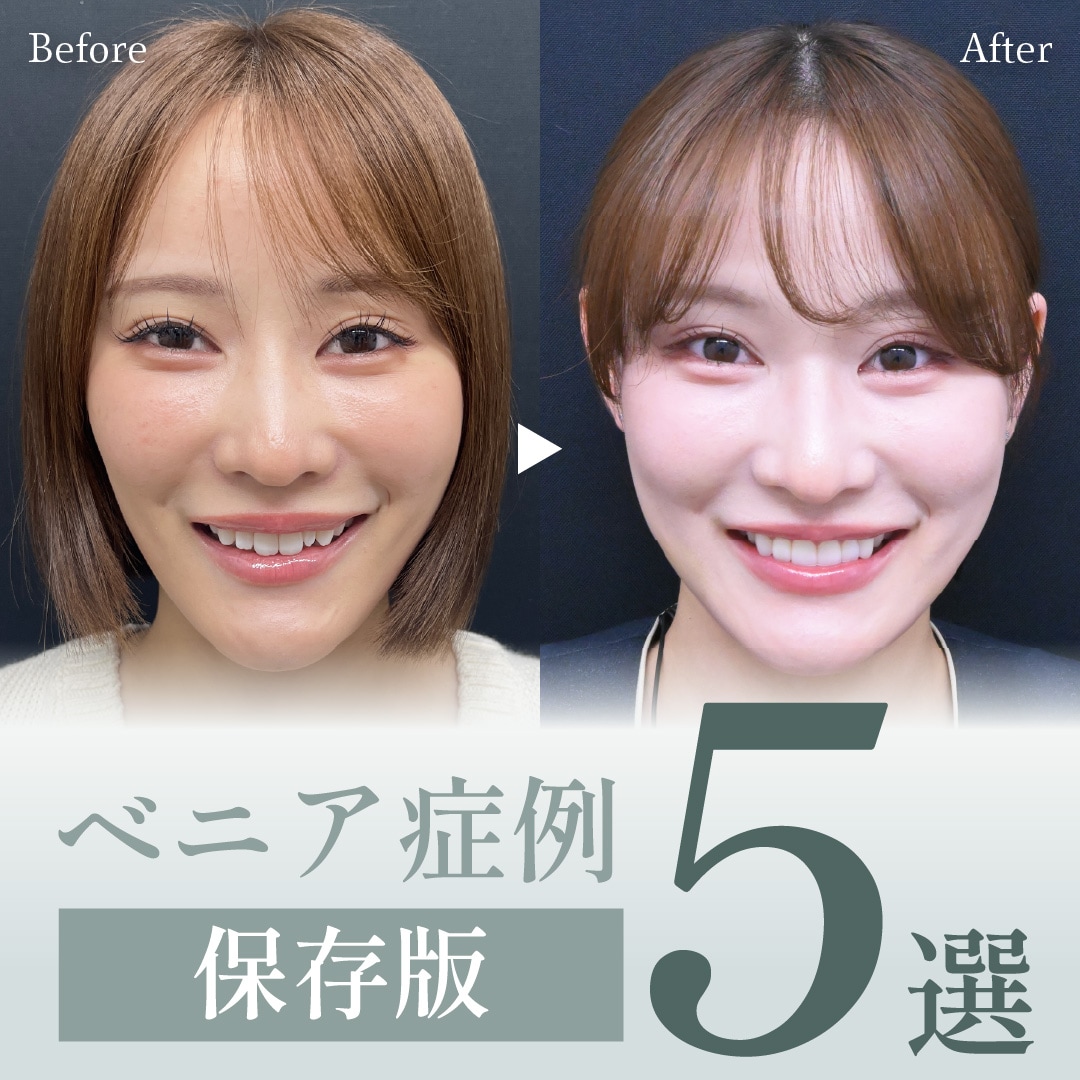 歯を削らない※「ラミネートベニア」実際の症例5選！【湘南歯科クリニック新宿院】