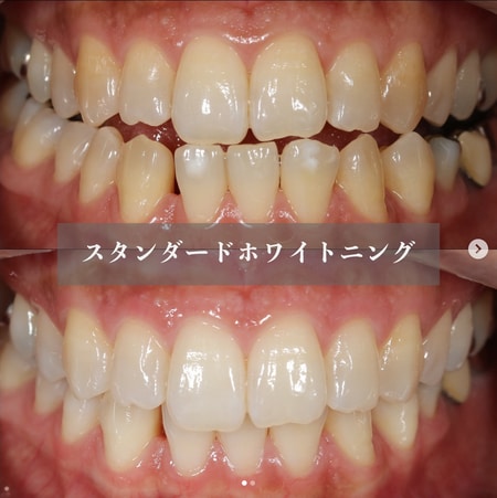 投稿③【スタンダードホワイトニング】