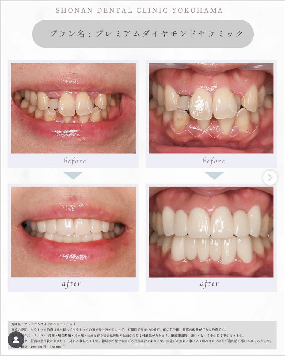 セラミック矯正(クラウン)