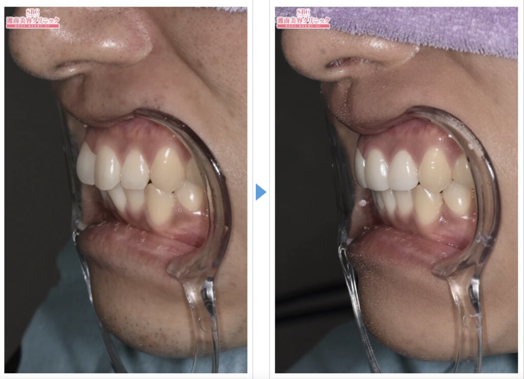 上前歯の歯並び・突出が改善された事例①