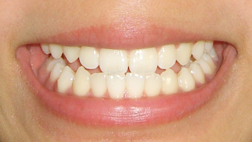 歯科矯正のレベリングにはどのくらいの期間が必要？