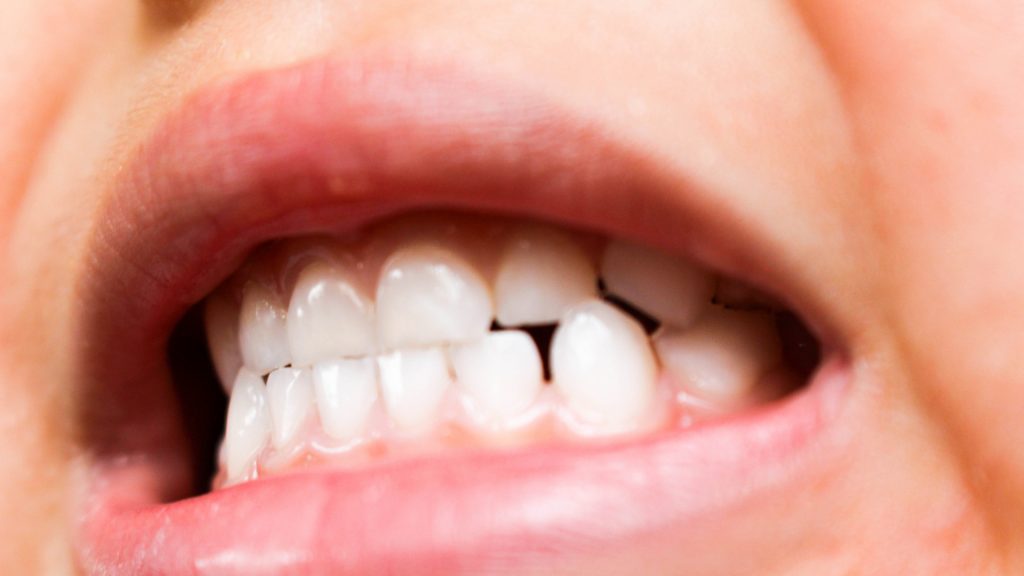 全てのアイテム 歯科矯正 顎間ゴム ゴムかけ 歯並び エラスティック ワイヤー インビザライン