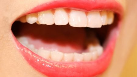 歯の表面の汚れを削ると黄ばみは取れるの？