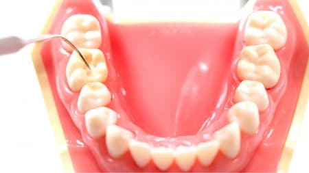 オールセラミックは奥歯の強度は足りる？