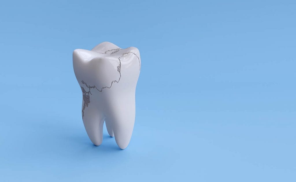 歯の根元が欠ける原因と治療方法｜放置しておくと虫歯になる可能性も