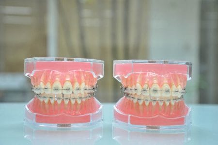 歯列矯正で歯が動きやすい人の特徴｜大人でも短期間で治療が終わる場合とは