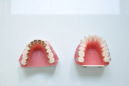 見えづらい歯の裏側矯正（舌側・リンガル矯正）の特徴・費用について