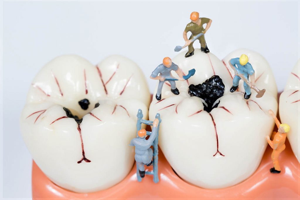 プラスチックの歯の詰め物とセラミックの違い｜歯科治療の値段や保険も説明