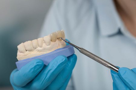 セラミック治療における前歯の仮歯期間