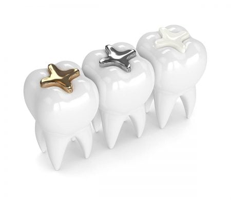 歯医者で使用される詰め物の種類