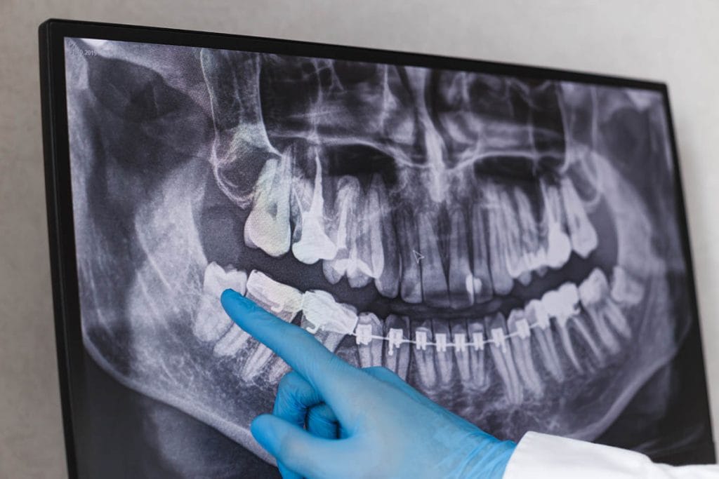 下の親知らずを抜歯すべきタイミング 抜歯後の痛みや生活への影響は 専門医が詳しく解説します ハコラム