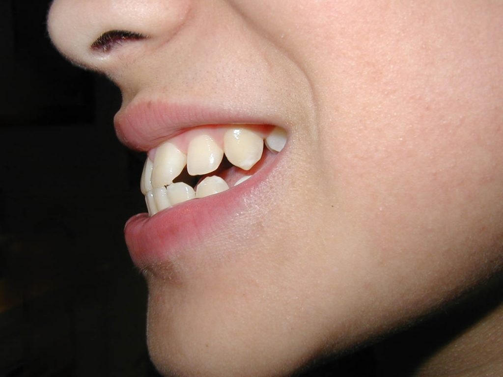 専門医が解説 セットバック治療で出っ歯や受け口を矯正 口元がきれいなeラインに ハコラム