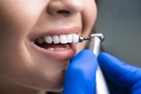 歯のクリーニングPMTCとは｜歯科での料金・保険・効果について紹介