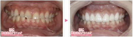 すきっ歯の矯正の症例写真3