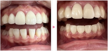 すきっ歯の矯正の症例写真1