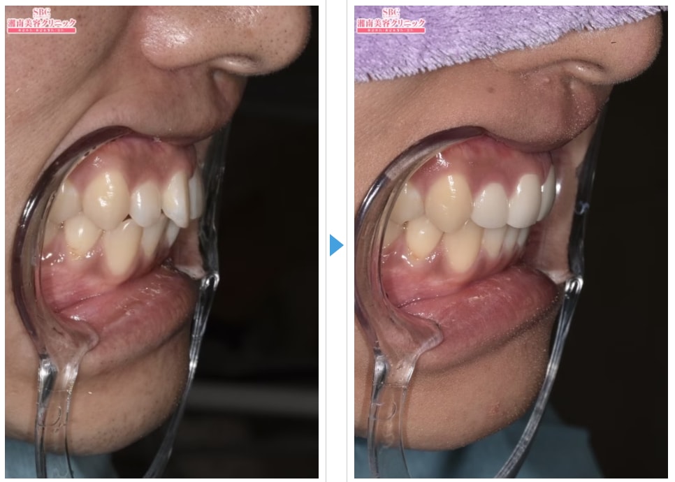 上前歯の歯並び・突出が改善された事例