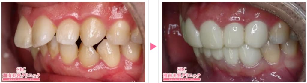 上前歯の歯並び・突出が改善された事例4