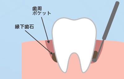 SPR治療