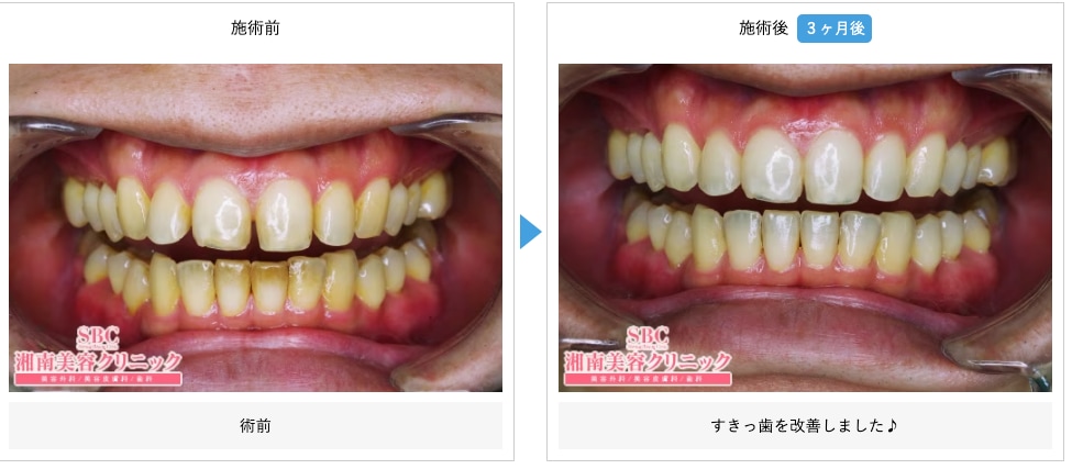 前歯専門矯正ー湘南マウスピースーの症例